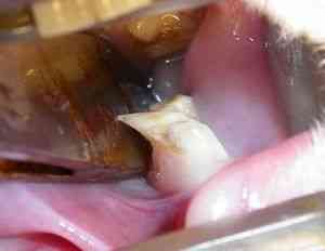 Отрастания на зубах, которые имеют неправильный прикус, могут вызывать повреждения тканей во рту и быть очень болезненными.